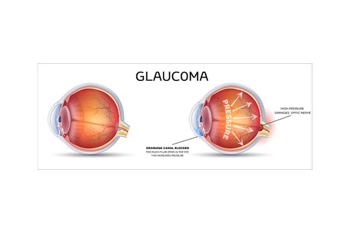 Глаукома латынь. Глаукома вектор.
